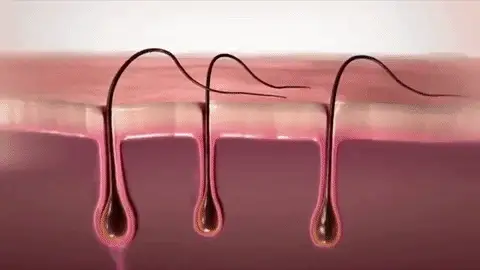 At Home Laser Hair Removal